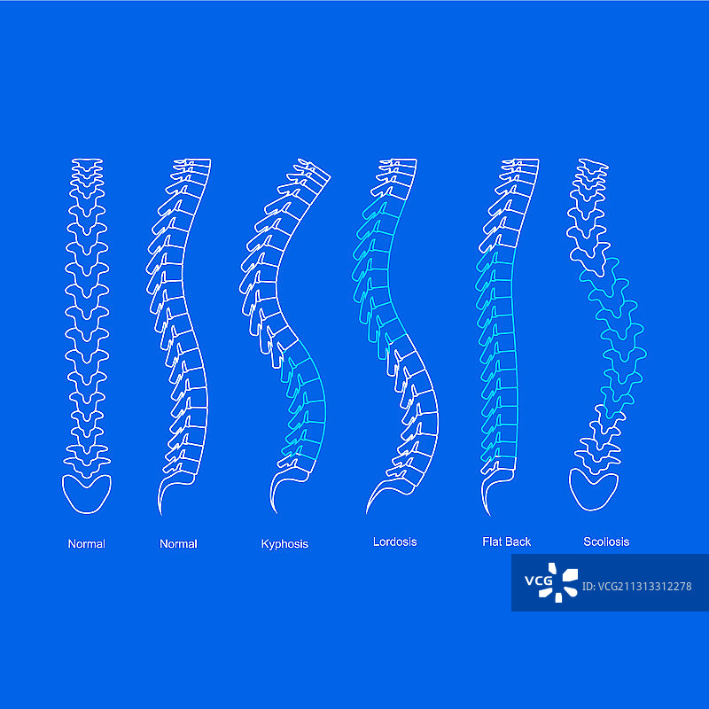 骨质疏松症骨骼类型信息图概念卡图片素材