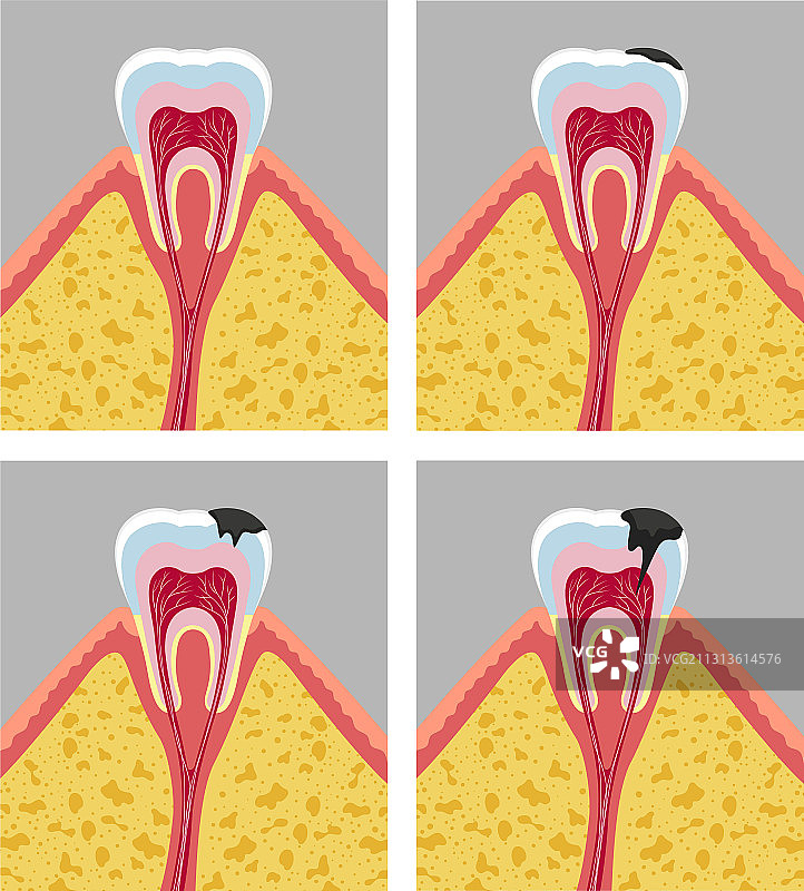 龋齿阶段图片素材