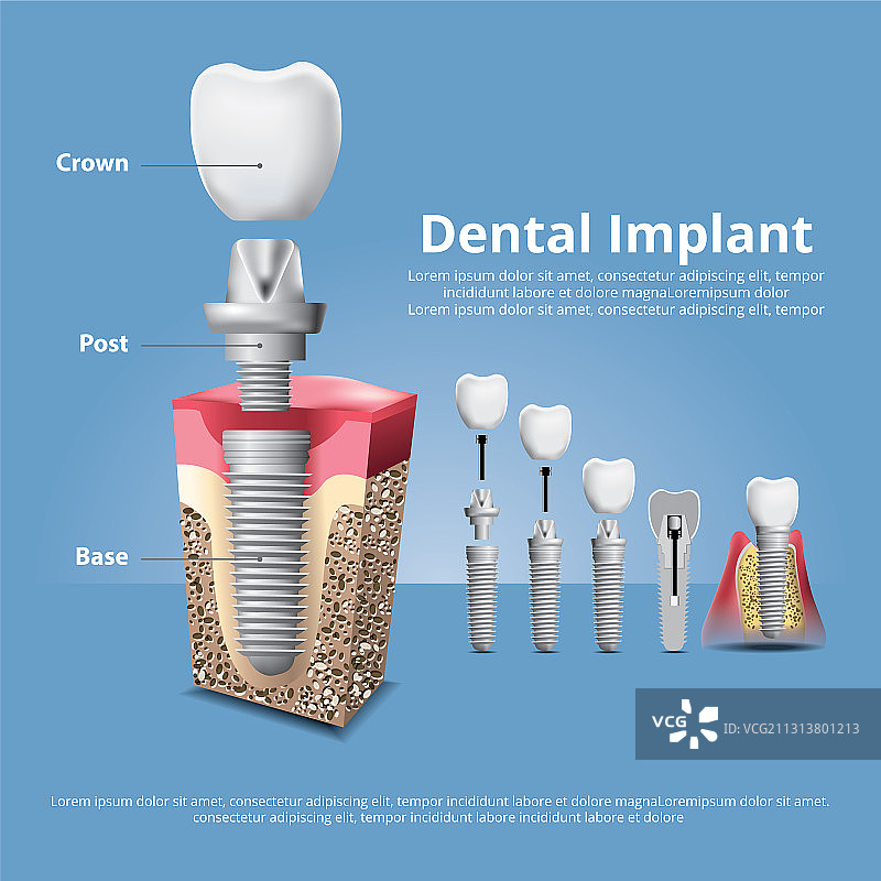 人的牙齿和牙科植入物图片素材