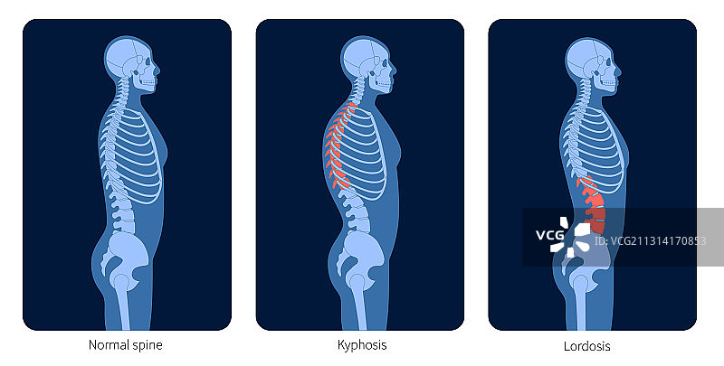 脊椎X光图片素材