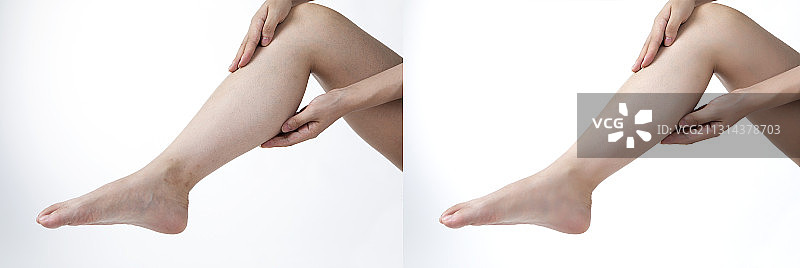 青年女人小腿肚水肿对比图图片素材