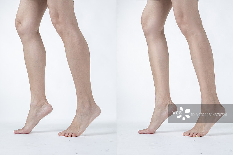中老年女人小腿肚水肿对比图图片素材