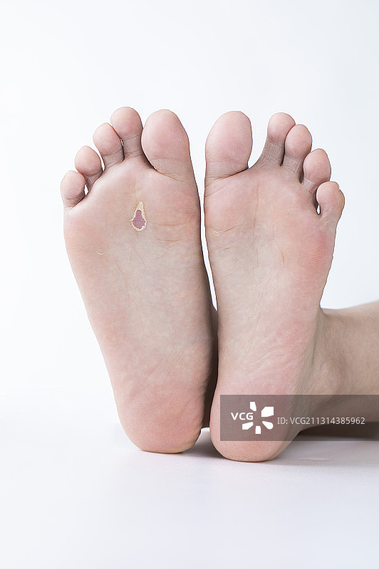 脚底破皮的青年女人图片素材