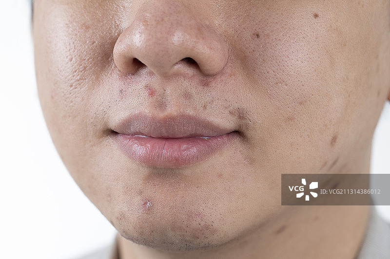 青年男人的皮肤面疱图片素材