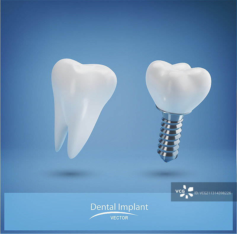 逼真的牙科植入物和健康的牙齿图片素材