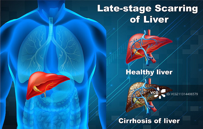 晚期肝脏瘢痕图片素材