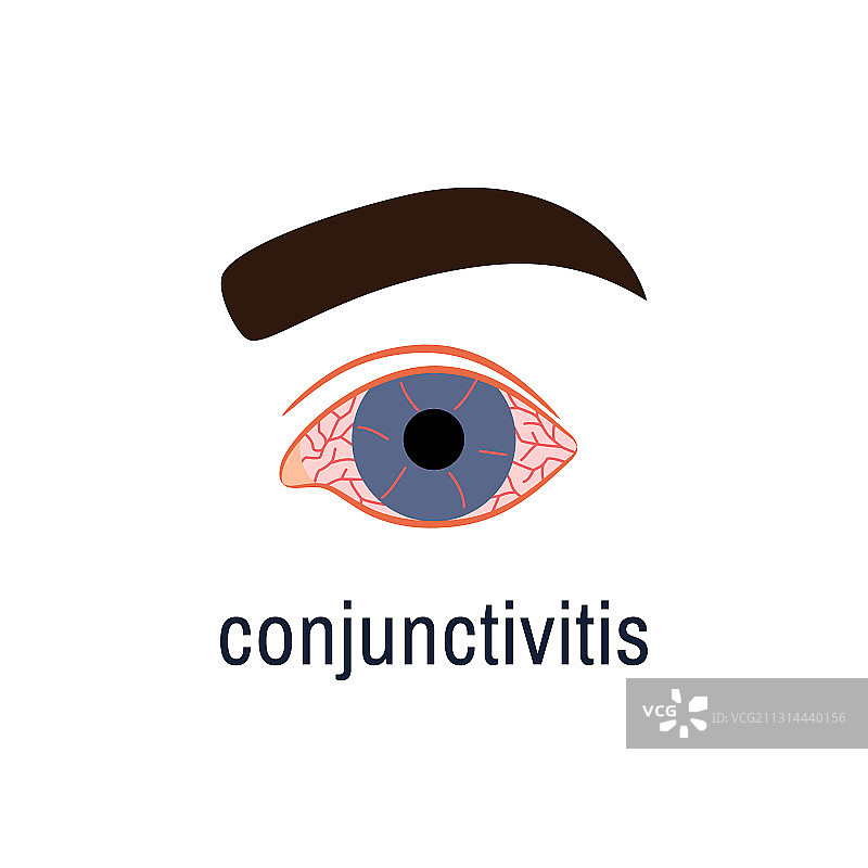 结膜炎图标，白色背景眼科疾病图片素材