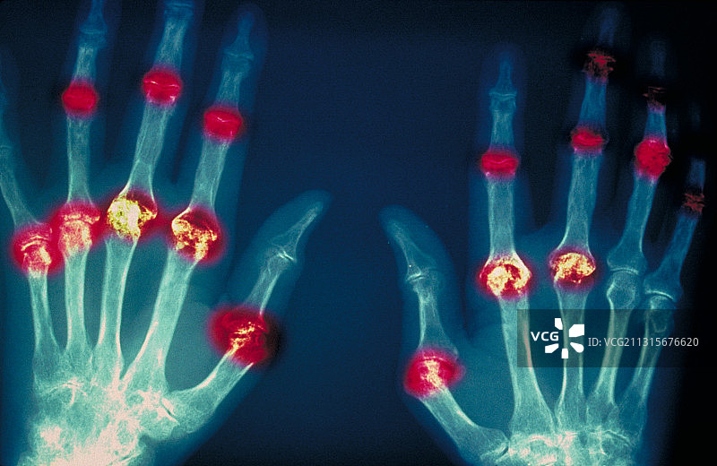 类风湿性关节炎图片素材