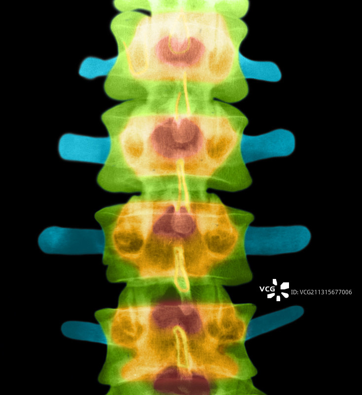正常脊柱图片素材