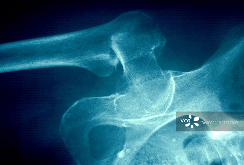 髋部骨折，骨质疏松症图片素材