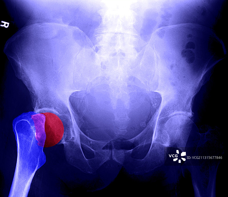 髋部骨折图片素材