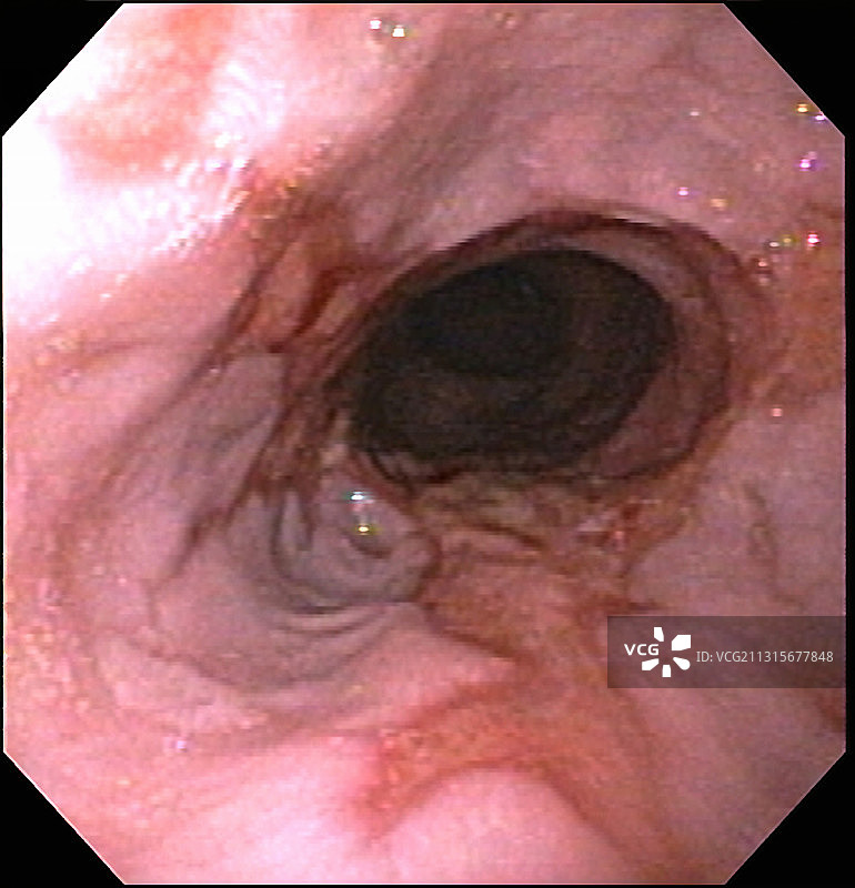 巴雷特食管图片素材