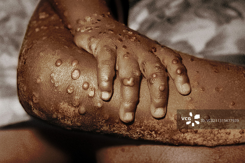 猴痘斑丘疹图片素材