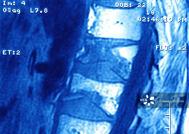 骨质疏松症图片素材