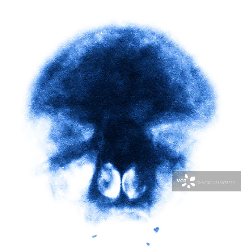 佩吉特病图片素材