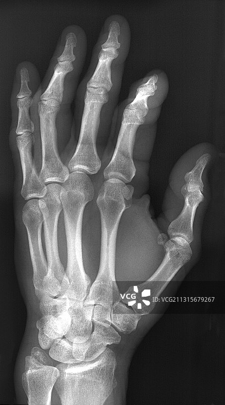 手指骨折图片素材