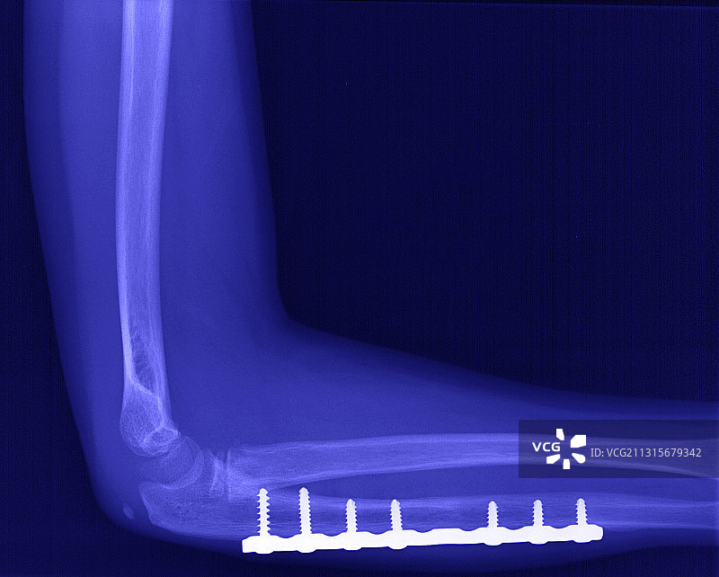 手臂骨折图片素材