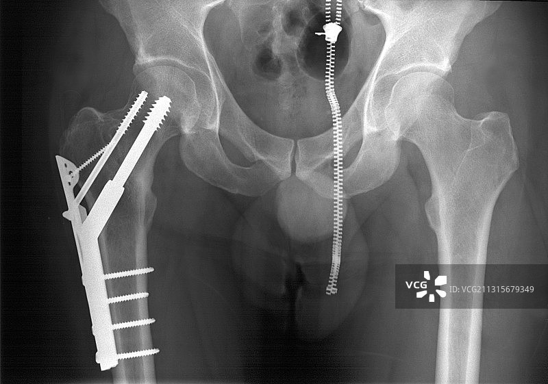 股骨骨折图片素材