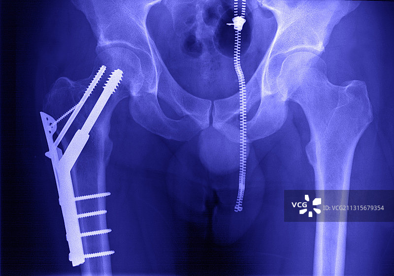 股骨骨折图片素材