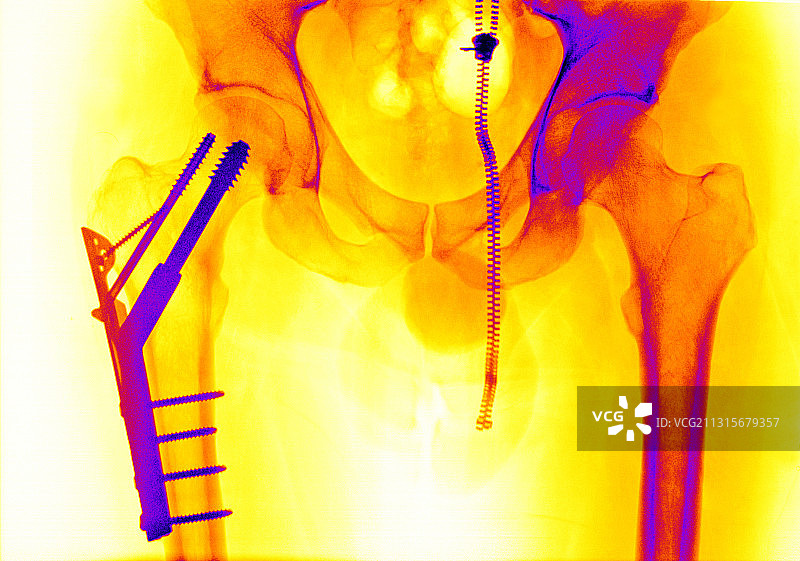 股骨骨折图片素材