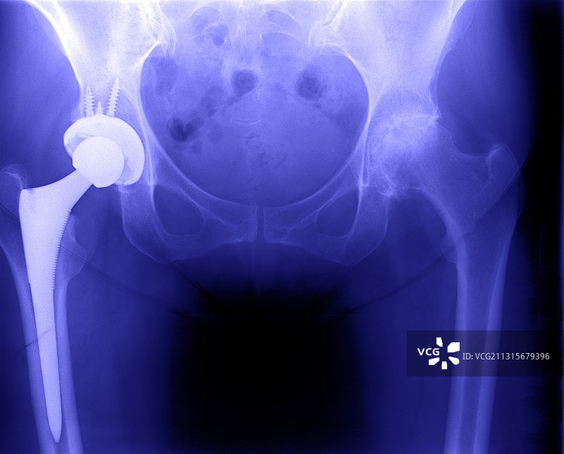 髋关节置换图片素材