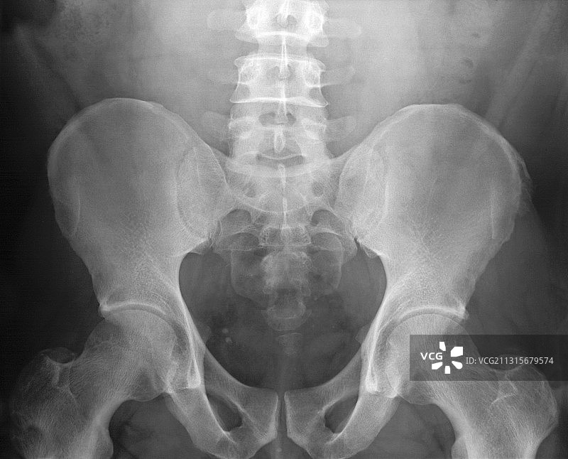 骨盆X光片图片素材
