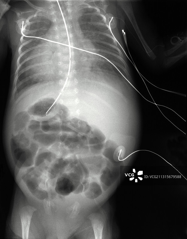腹胀X光片图片素材