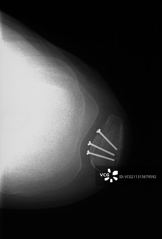 膝盖骨螺丝的X光片图片素材