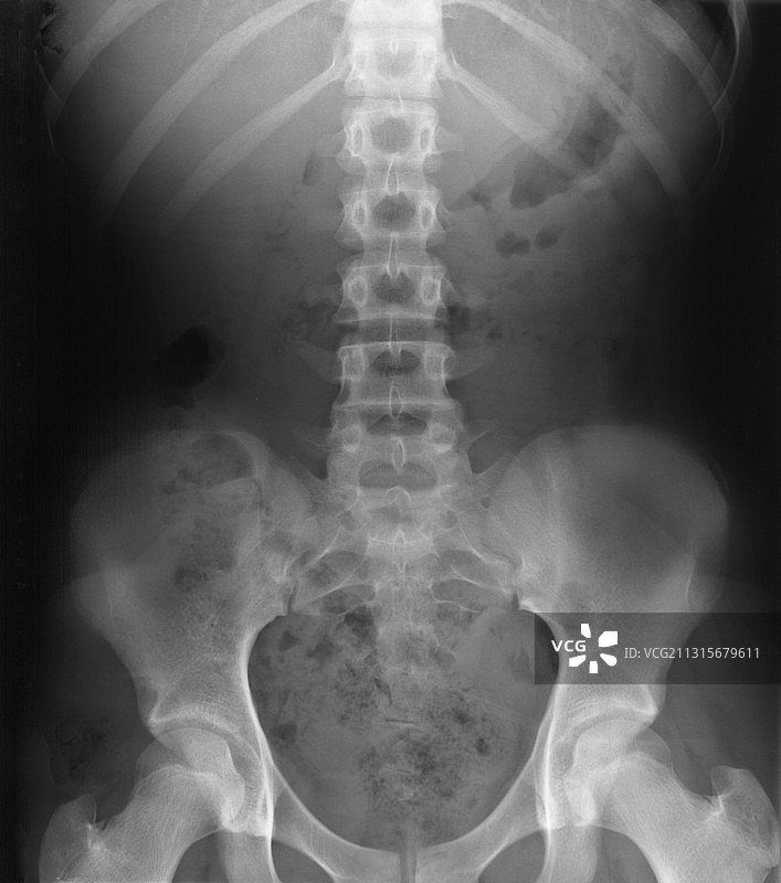 腰部和骨盆X光片图片素材