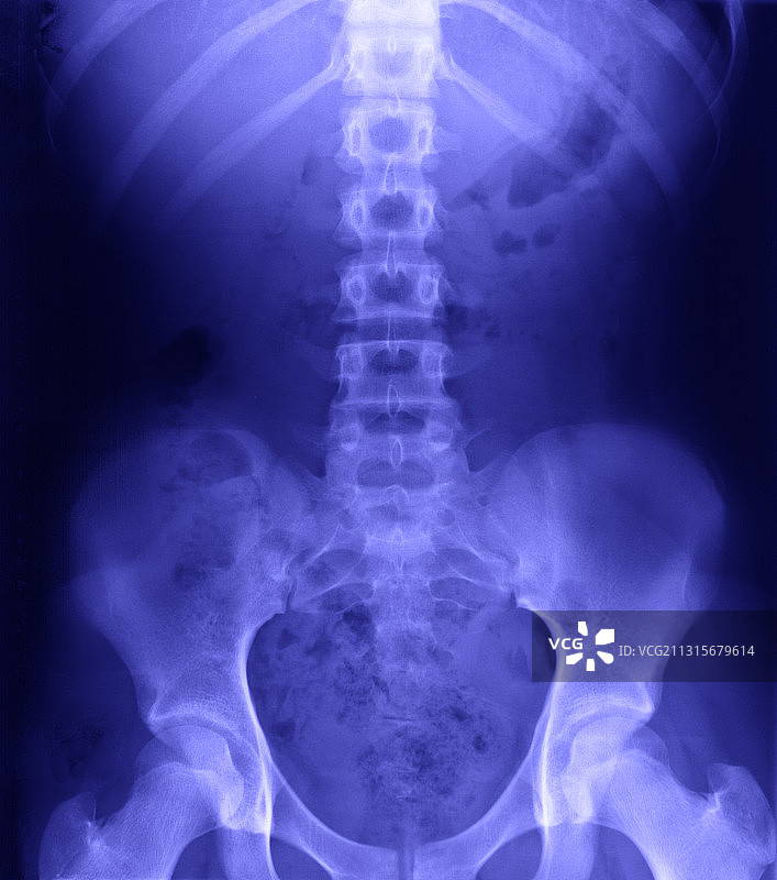 腰部和骨盆X光片图片素材
