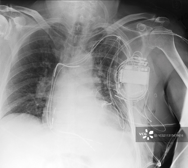 心脏起搏器的X光片图片素材