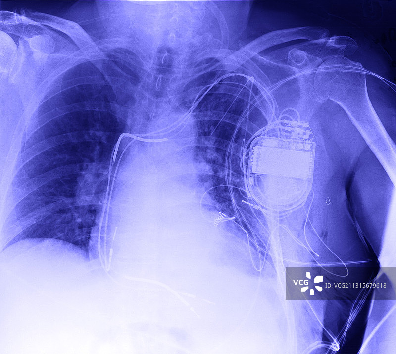 心脏起搏器的X光片图片素材
