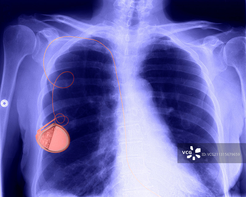 心脏起搏器X光片图片素材