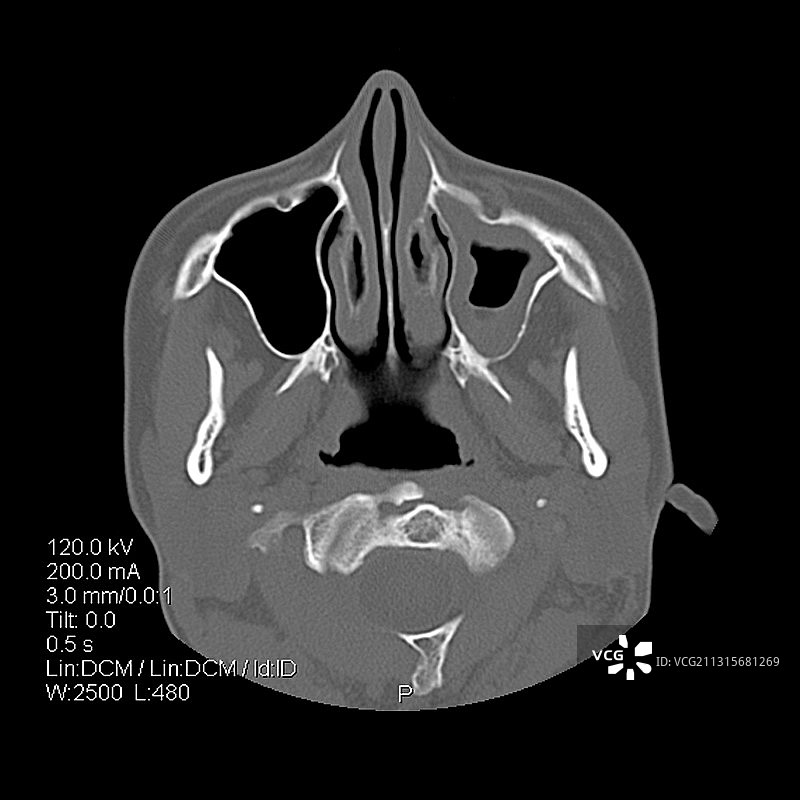 鼻旁窦图片素材