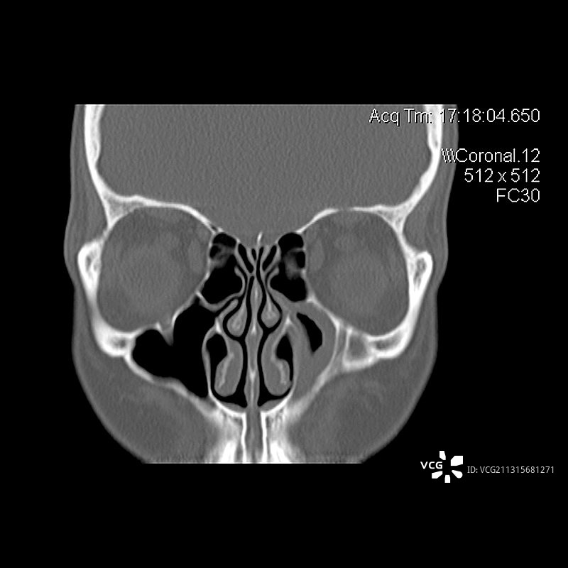鼻旁窦图片素材
