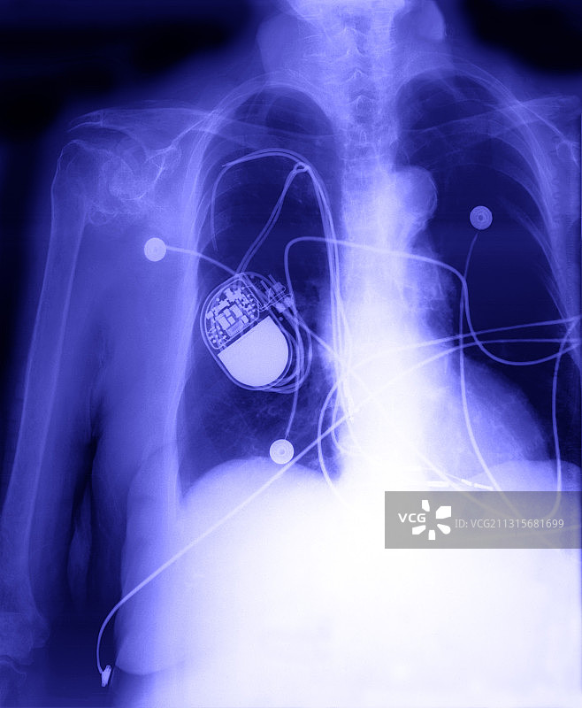 心脏起搏器图片素材