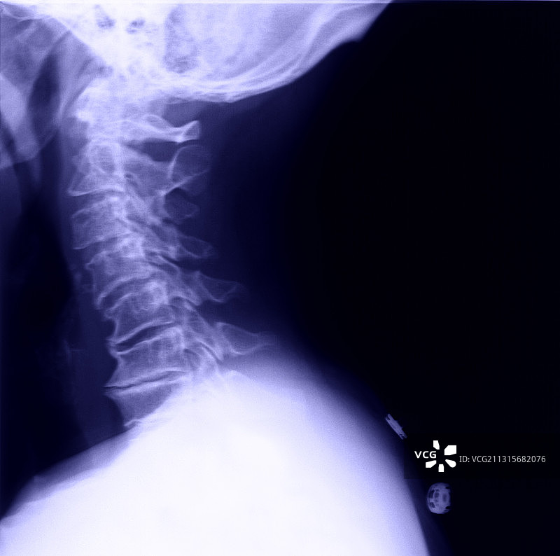 骨质疏松症图片素材