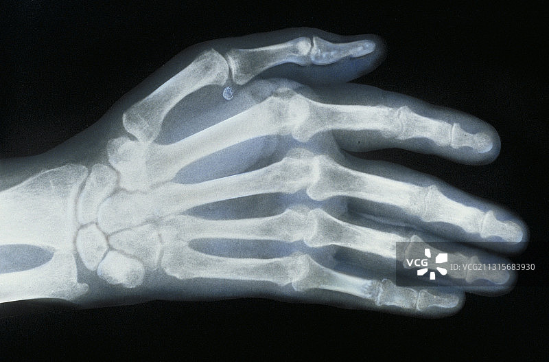 类风湿性关节炎图片素材