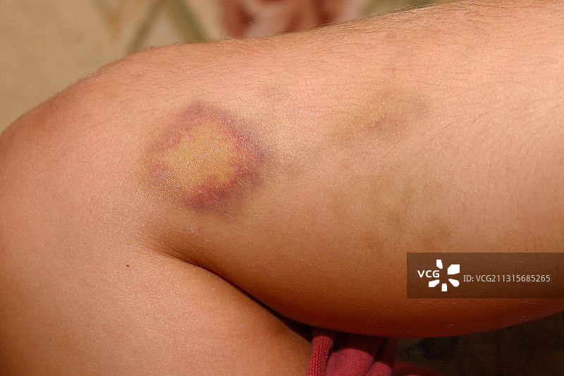 腿部瘀伤图片素材