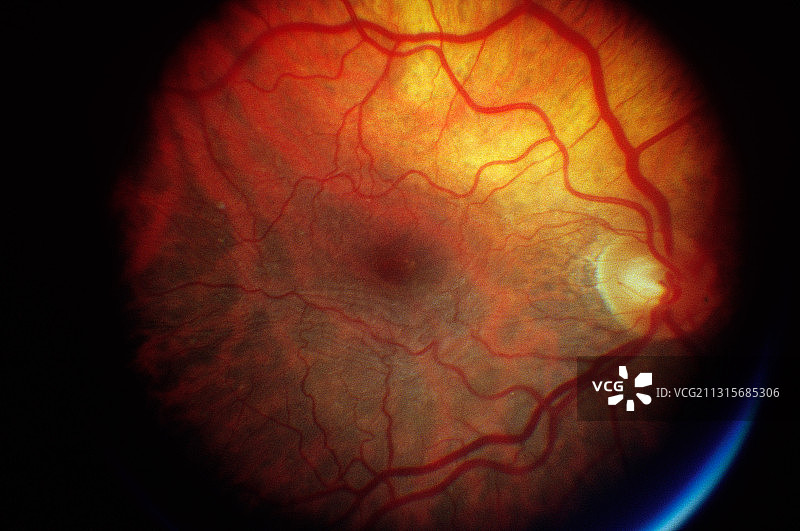年龄相关性黄斑变性图片素材