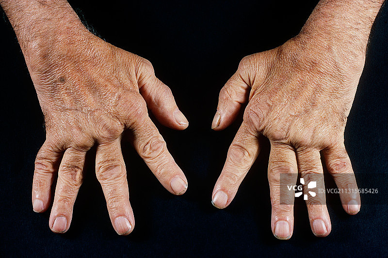 类风湿关节炎图片素材