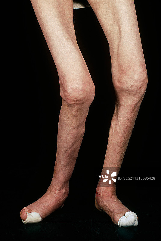 类风湿关节炎图片素材