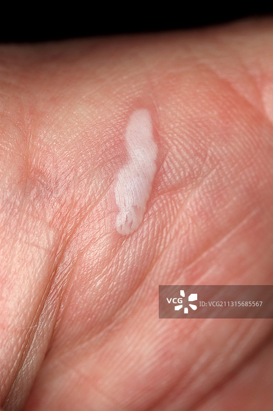 手部烧伤图片素材