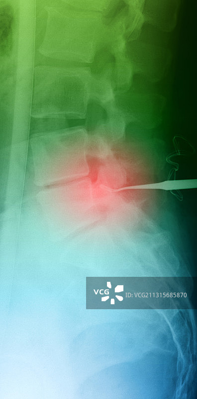 下脊柱X光片图片素材