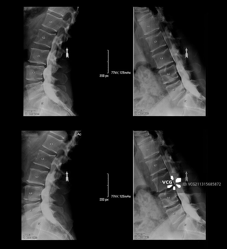 脊椎X光片图片素材