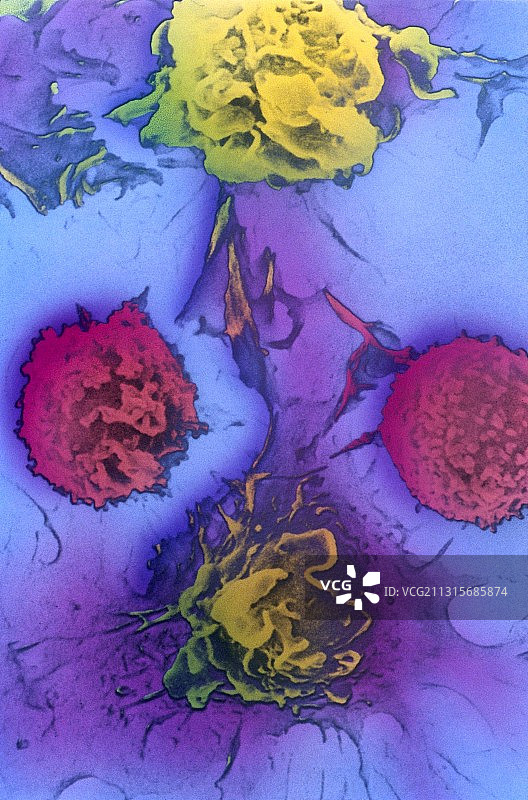 癌细胞和淋巴细胞，扫描电镜图片素材