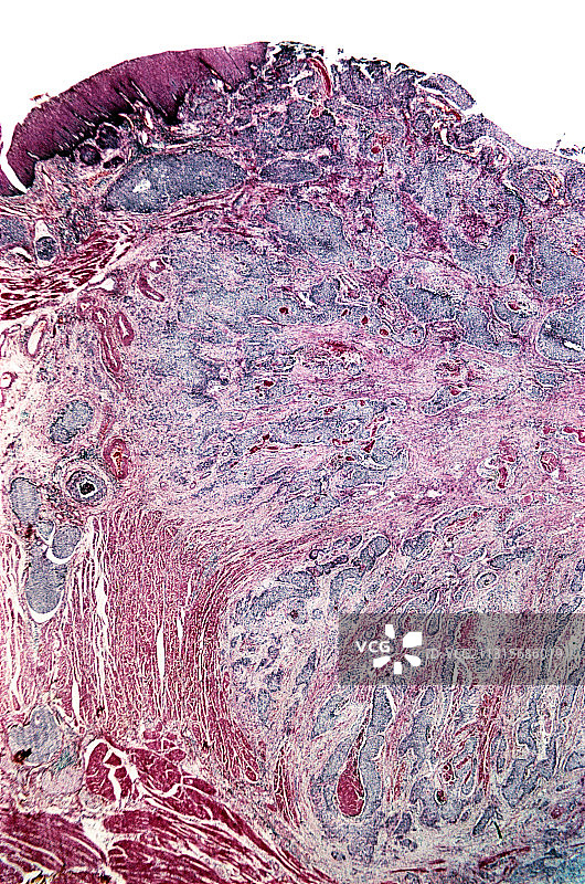 巴雷特食管浅显显微照片图片素材