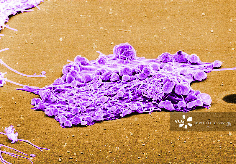 乳腺癌肿瘤细胞图片素材