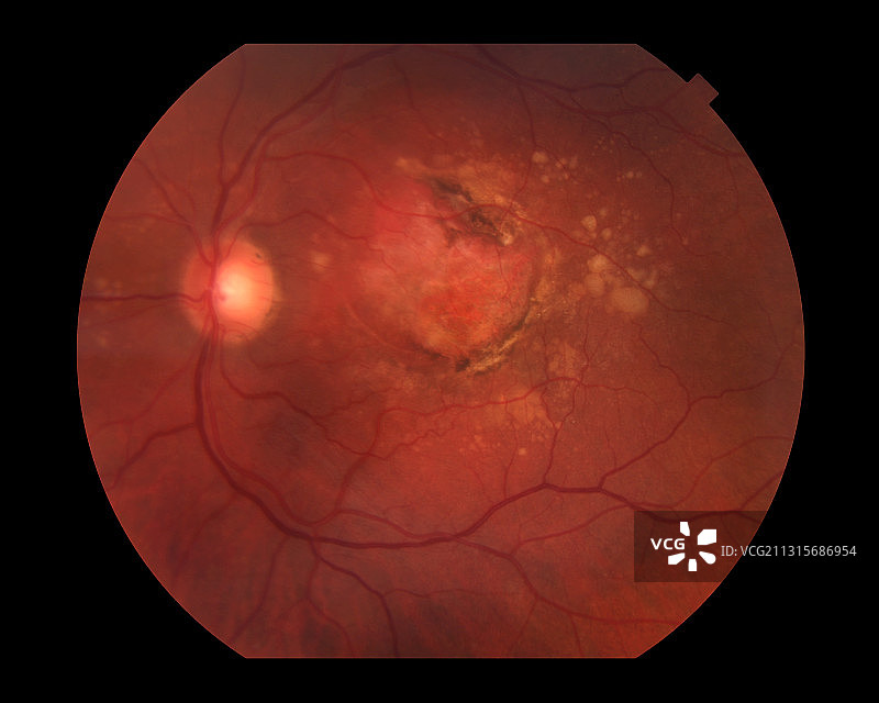 湿性老年黄斑变性图片素材