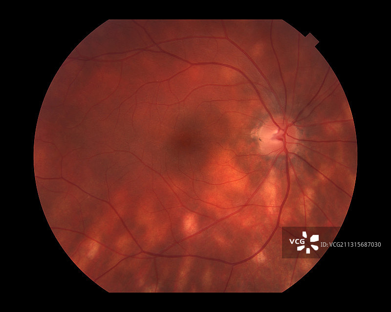 鸟枪状脉络视网膜病变图片素材